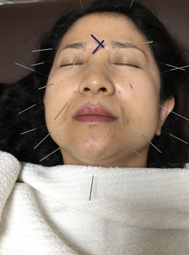 メニュー:美容鍼コース イメージ
